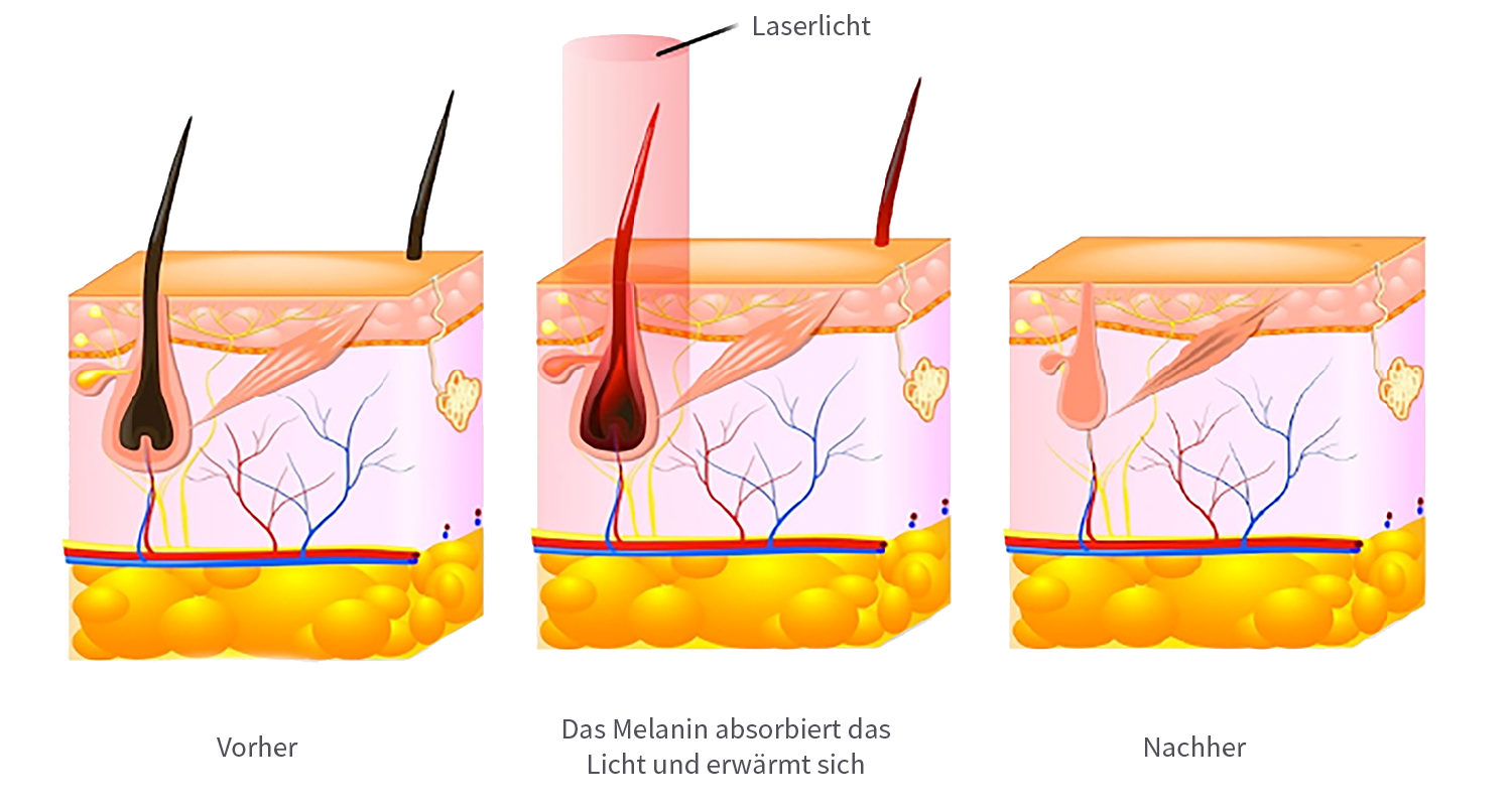 Laser vs. IPL – Unterschied Haarentfernung – Just Relax Wien
